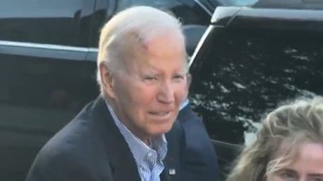 Hautkrebs!  - Joe Biden mit riesiger Narbe am Kopf