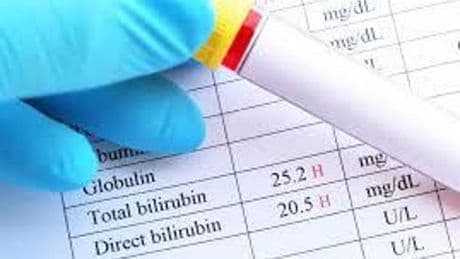 Bilirubin Ne Demek? Bilirubin Yüksekliği Ve Düşüklüğü Ne Anlama Gelir?