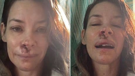 Marvel's Evangeline Lilly reveals gruesome injuries after being rushed to hospital