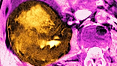 Liver Cancer Cases Are On The Rise. Here’s How To Avoid Getting It