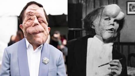 Adam Pearson sera le premier acteur handicapé à incarner Elephant Man dans une nouvelle adaptation