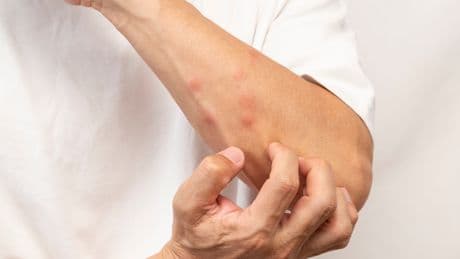 This new bug bite zapper plugs into your phone — how it works to ease itch in seconds