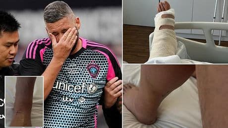 Tony Bellew admits 'pain is real' after surgery on gruesome Achilles injury suffered in Soccer Aid game - after saying it felt like he 'had been shot'