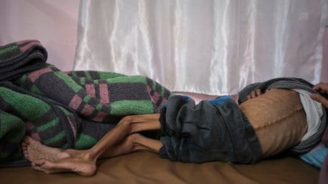 Children so malnourished they’re losing their sight: Inside Israel’s aid blockade on Gaza