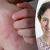 “Vlekken die snel opduiken en verdwijnen duiden op netelroos, géén allergie”: dermatoloog geeft advies over ziekte die 1 op de 5 treft