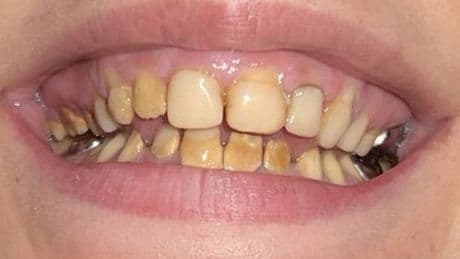 'I was bullied for my crumbling teeth - £5,000 smile cured my resting b***h face'