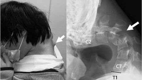 Dropped-Head-Syndrom - Zu lang am Handy! Gamer  kann Kopf nicht mehr heben
