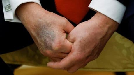 Lo que la mancha de la mano de Trump revela sobre su salud