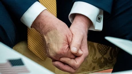 Trump Diagnosed With Chronic Venous Insufficiency After Leg Swelling. What Is It?