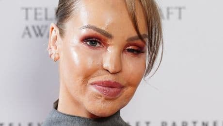 Katie Piper says man threw sandwich at her after noticing facial burns