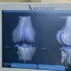 Les industriels du secteur des prothèses orthopédiques alertent sur un risque de pénuries d'implants