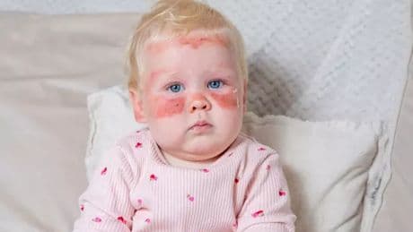 Scots baby left with 'severe burns' despite wearing factor 50 sun cream amid heatwave