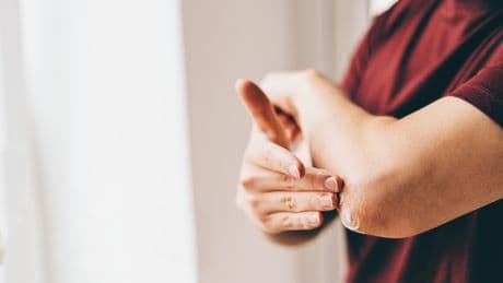 Seborrhoisches Ekzem: Ursachen und Behandlungen