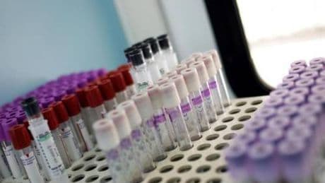 Mielofibrosi, speranze da nuovo farmaco che limita l'anemia in 2 pazienti su 3