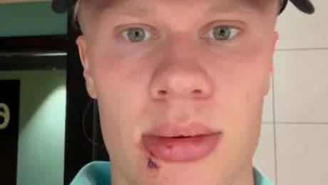 Erling Haaland 'blames Martin Odegaard' for freak injury suffered on international duty