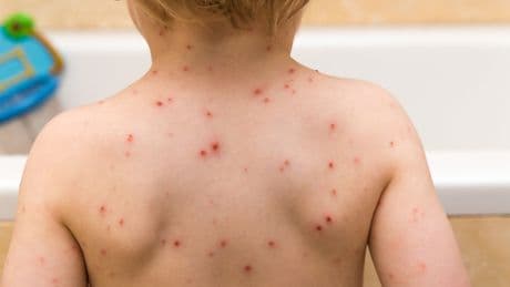 Scientists ‘slash risk of Alzheimer’s’ with medicine used to treat cold sores