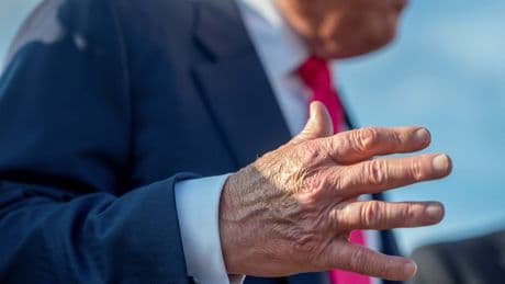 Dicke Knöchel, Bluterguss am Handrücken - Wie krank ist Trump?