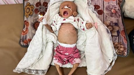 El hambre se agrava en Gaza por el bloqueo israelí: más de 110 muertos por malnutrición y fotos de niños esqueléticos