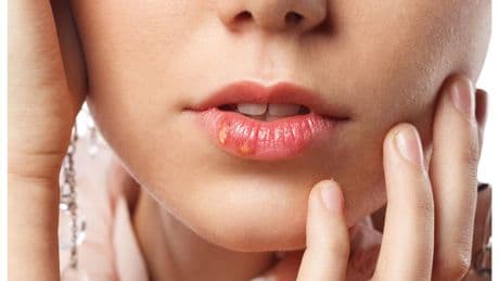 Treating cold sores with anti-virals ‘may slash risk of developing Alzheimer’s’