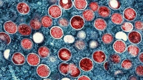 Krankheiten: Mehr Fälle von Mpox – aber Experte bislang gelassen