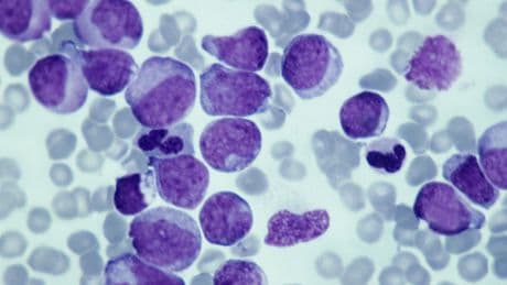 Leucemia mieloide, il tumore di Achille Polonara: cause, sintomi, fattori di rischio, diagnosi e terapia