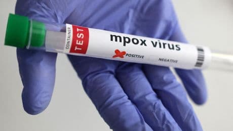 KDC’de Mpox alarmı: 5 ayda 9 binden fazla vaka