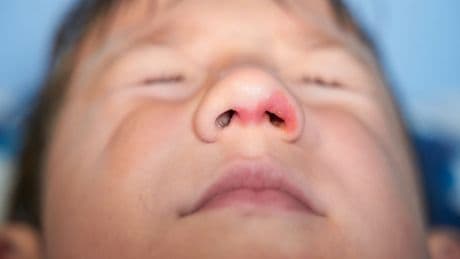 Impetigo Contagiosa: Symptome und Behandlung