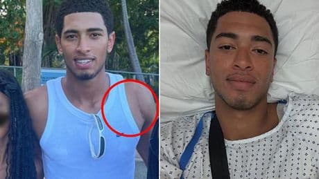Jude Bellingham reveals nasty-looking shoulder scar after England star went under the knife following TWO-YEAR ordeal with secret issue