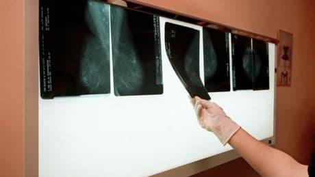 Prostate, testicules, sein: BNP Paribas ne veut plus priver de crédit les anciens malades du cancer