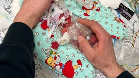 265 Gramm leichtes Frühchen: „Dieses Mädchen ist ein kleines Wunder“