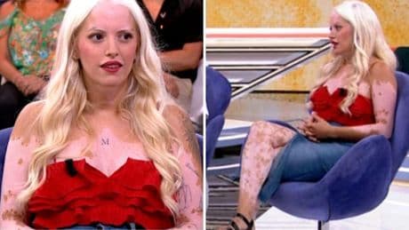 Melissa (29 años), sufre de piebaldismo desde que nació: "Me llamaban 'dálmata' por las manchas en mi piel"