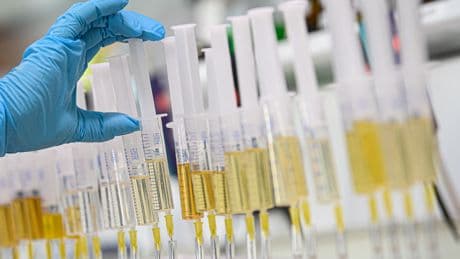 Achtung Warnsignal: Diese Urinfarbe kann auf ein Problem hinweisen