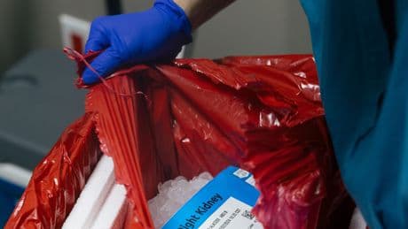 Organ Donation: What to Know About the Process