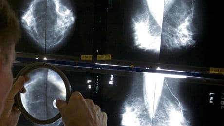 Which cancers are increasing in younger adults? A new study has answers