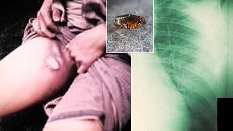 Cases of 'ancient disease' now spread to four states after first patient fell ill from flea bite