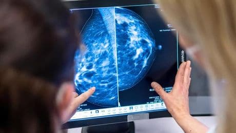 Krebserkennung: Mammografie-Screening senkt Sterblichkeitsrate bei Brustkrebs