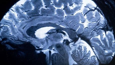 That mystery brain disease plaguing people in New Brunswick? A new study finds it's not real