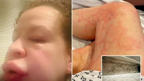 Mum’s face ‘blew up’ and painful red blisters engulfed her whole body after she spotted black mould spores in her home