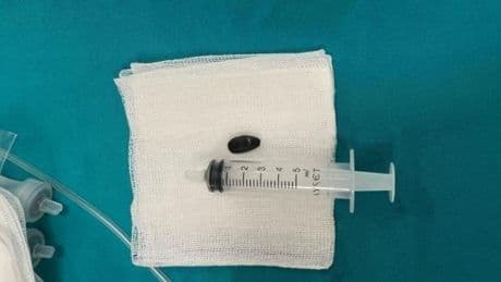 Akciğerine çekirdek kabuğu kaçtı! 15 aylık bebek acil müdahaleyle kurtarıldı