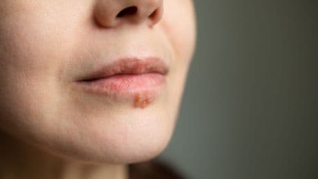 Cold sore treatment could ‘slash risk of developing Alzheimer’s by 17%’, say scientists