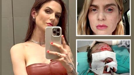 I was left blind and in a 17-day coma after taking ibuprofen for period cramps – I was burning from the inside out