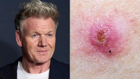 Gordon Ramsay's Skin Cancer Can Show Up As A 'Spot' – Here's How To Check Yours