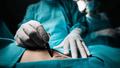 Liposuktion bei Lipödem wird in allen Stadien Kassenleistung – das gilt