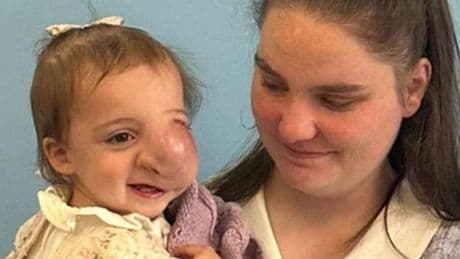 Tot dies from cancer after doctors assumed lump on face was 'caused by parents'