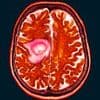 Hundreds of women ready to sue over contraceptive jab linked to brain tumours - as doctor warns prescribing drug 'verges on medical negligence'