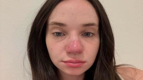 Woman left with permanent sunburned red nose after falling asleep on holiday