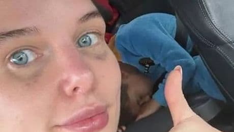 Coronation Street's Helen Flanagan shows off painful 'black eye' after surgery