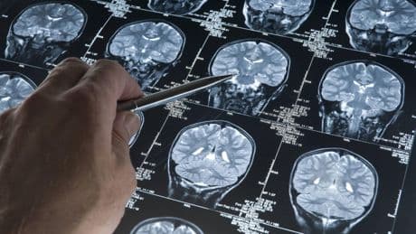 Paso de gigante para la cura del alzhéimer y el párkinson: desentrañan el mapa proteico de la neurodegeneración