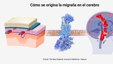 Llegan nuevos fármacos para prevenir los ataques de migraña