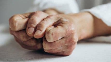 Lo studio, inibitore Il-23 riduce segni e sintomi artrite psoriasica attiva
